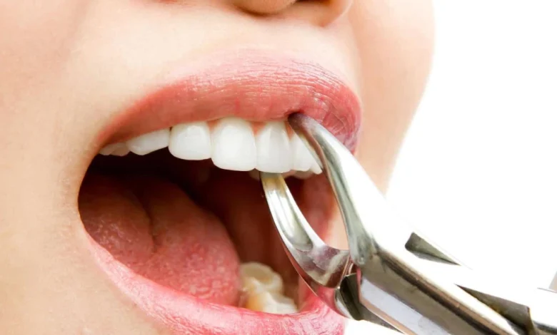 تفسير حلم خلع الطاحونة