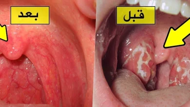 علاج التهاب الحلق
