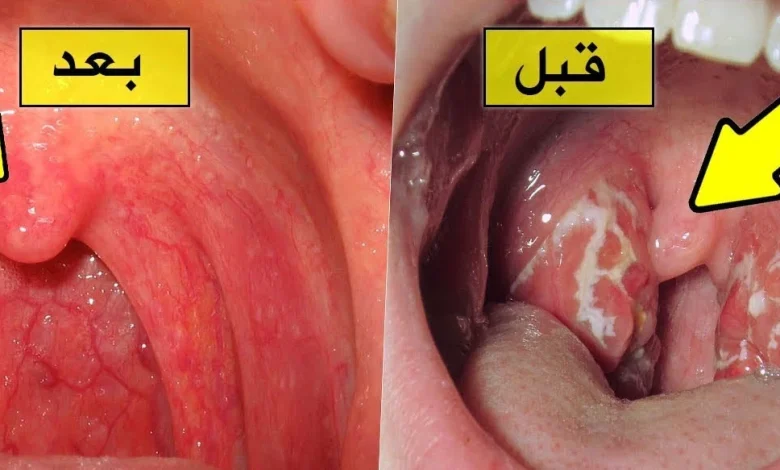 علاج التهاب الحلق