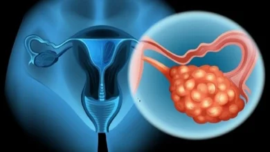 علاج قرحة الرحم