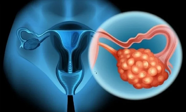 علاج قرحة الرحم
