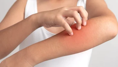 حساسية الجلد