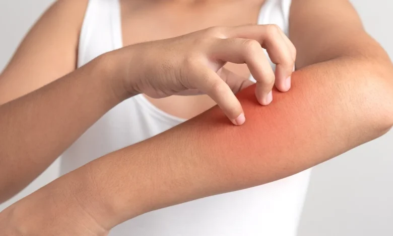 حساسية الجلد