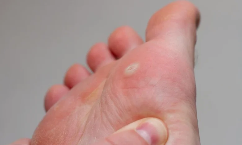 علاج عين السمكة بالرجل