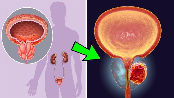 علاج البروستاتا بالأعشاب