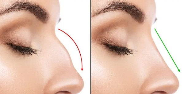 عمليات تجميل الأنف في ألمانيا