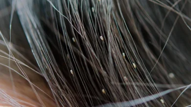 الحلم بقمل في الشعر