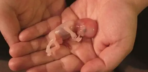 الاجهاض في المنام