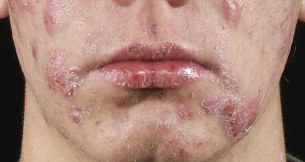 طرق علاج حب الشباب بسرعة