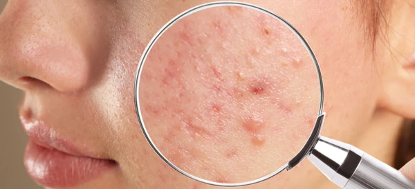 طرق علاج حب الشباب بسرعة