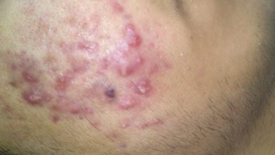 طرق علاج حب الشباب بسرعة