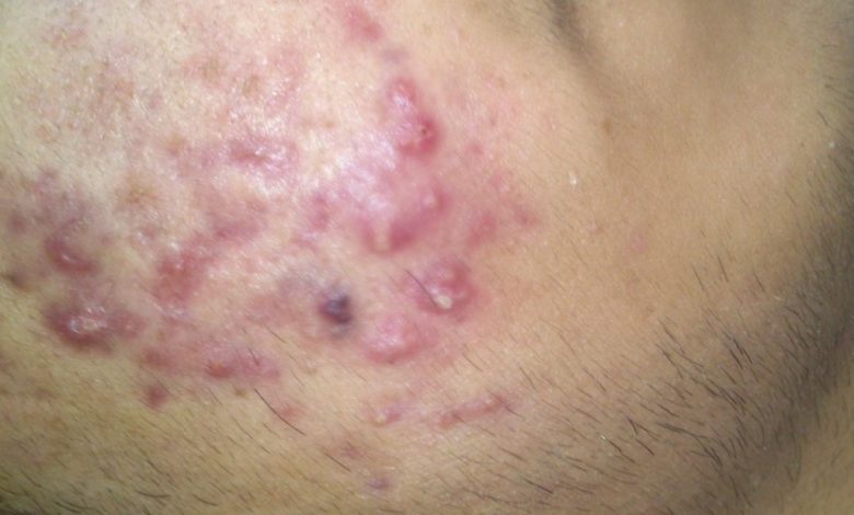 طرق علاج حب الشباب بسرعة