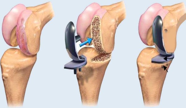 خشونة الركبة