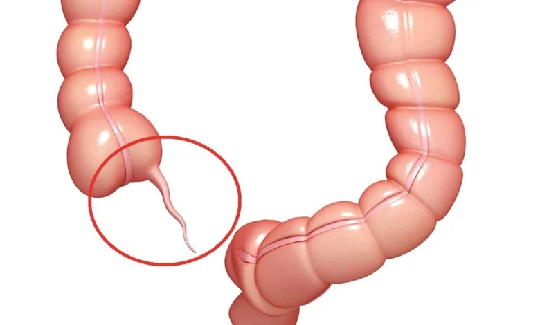 الزائدة الدودية عند النساء