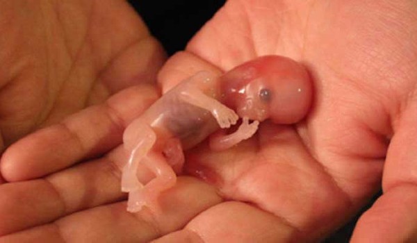 حكم اجهاض الجنين