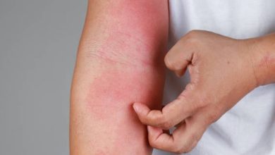 أسباب حساسية الجلد