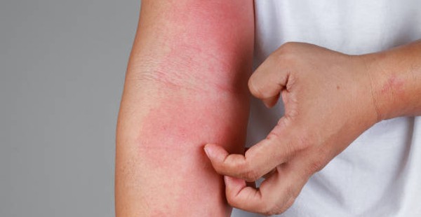 أسباب حساسية الجلد