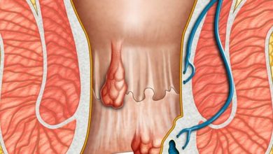 علاج البواسير في المنزل