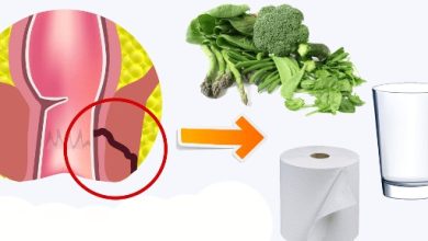 علاج الناسور العصعصي بدون جراحة