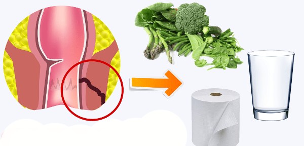 علاج الناسور العصعصي بدون جراحة