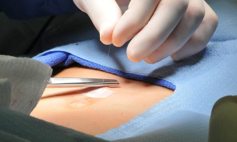 عملية الفتاق