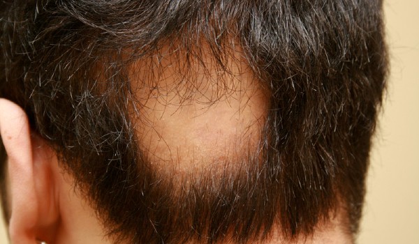 كيف أعرف أنها ثعلبة