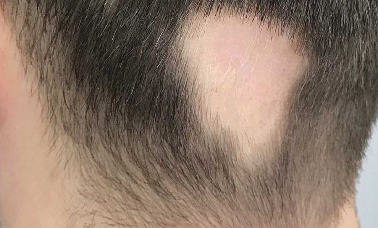 كيف أعرف أنها ثعلبة